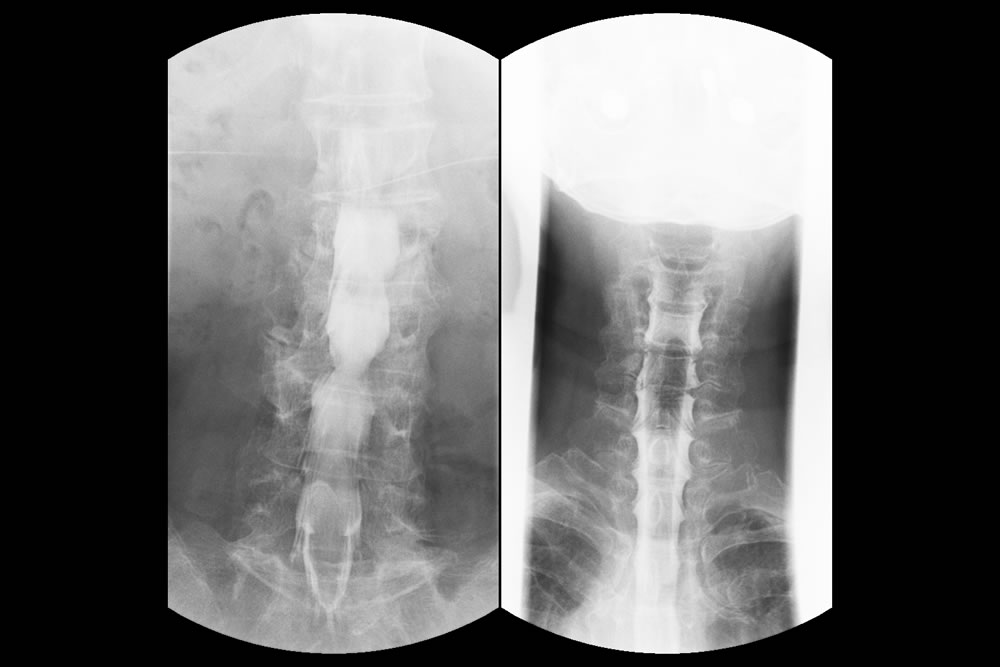 腰椎(左)　頸椎(右)<br>脊髄腔造影