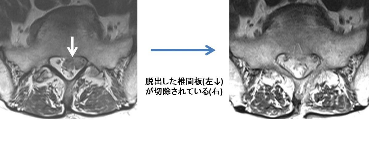 脊椎脊髄疾患 | 医療法人泰庸会 新潟脳外科病院