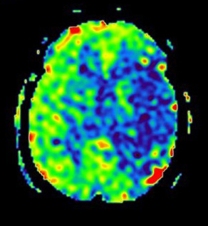 灌流画像(脳虚血)　1.5テスラ MRI装置　SIGNA Creator