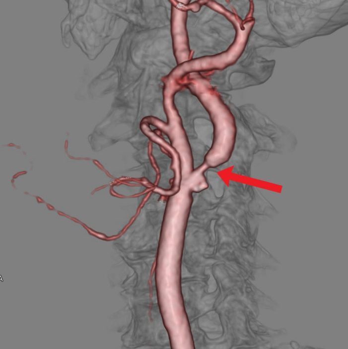 頸部３DCTA（内頚動脈起始部狭窄）